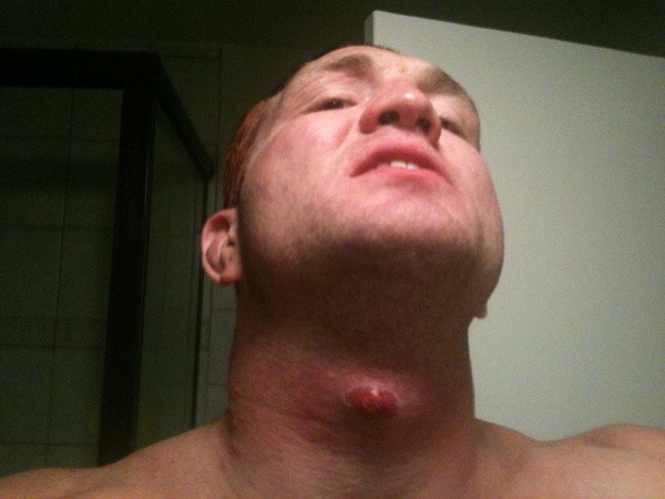 Ex-UFC fighter Jason Miller developed an infection in his throat after a fight